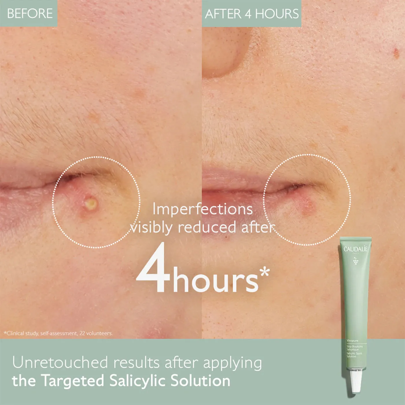 Caudalie Vinopure Color Correcting Spot Solution with Salicylic Acid 15ml NIB