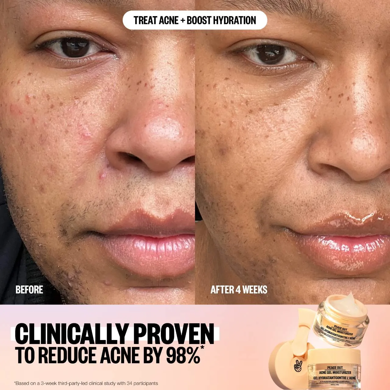 Peace Out 2% Salicylic Acid Acne Gel Moisturizer 50ml NIB
